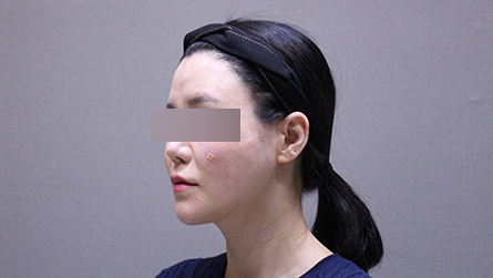 사례5 시술 후 측면