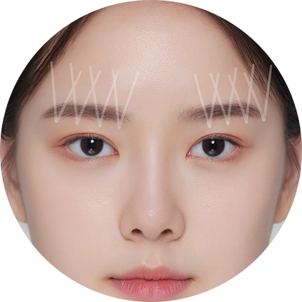 이마거상 실리프팅 전